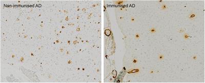 Amyloid-β and α-Synuclein Immunotherapy: From Experimental Studies to Clinical Trials